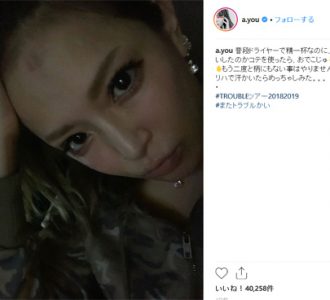 浜崎あゆみ、額にやけど　痛々しい写真にファン心配の声